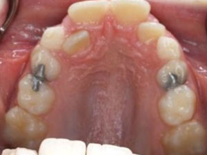 8 year patient's orthodontic treatment