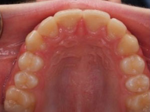 teeth after orthodontic treatment