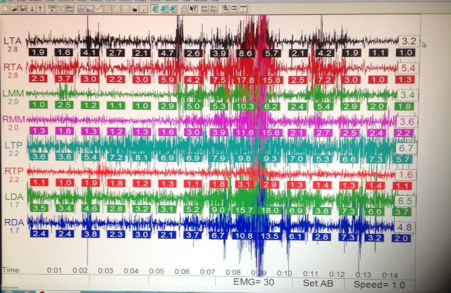 recording of tmj patient with sleep breathing disorder