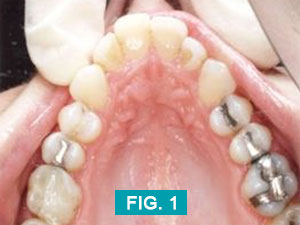 teeth before upperarch treatment