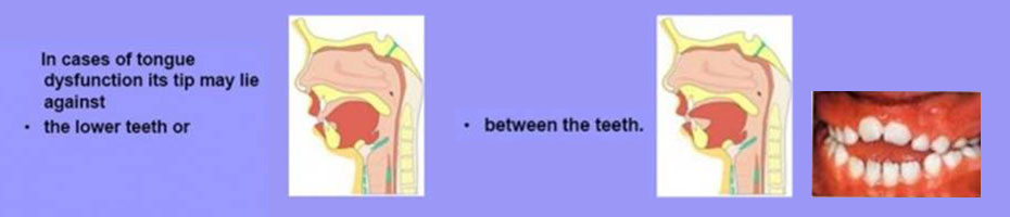 diagram of tongue dysfunction